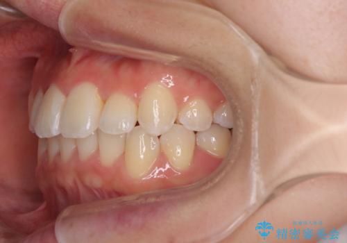 前歯のクロスバイト 裏側に隠れた歯をワイヤー装置で短期間治療の治療後