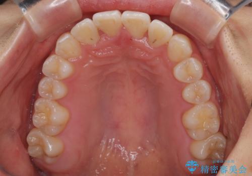 前歯のクロスバイト 裏側に隠れた歯をワイヤー装置で短期間治療の治療後
