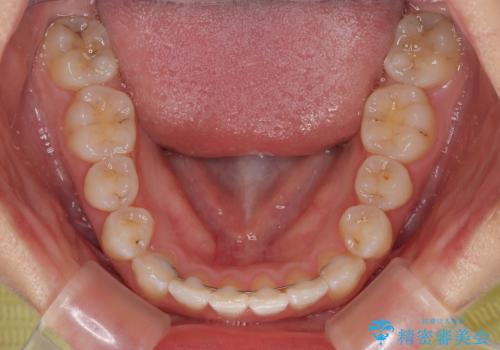 前歯のクロスバイト 裏側に隠れた歯をワイヤー装置で短期間治療の治療後
