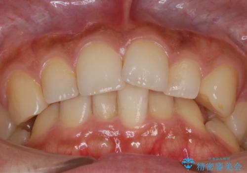 【非抜歯】ゴムかけで噛み合わせを改善!インビザライン治療の治療前
