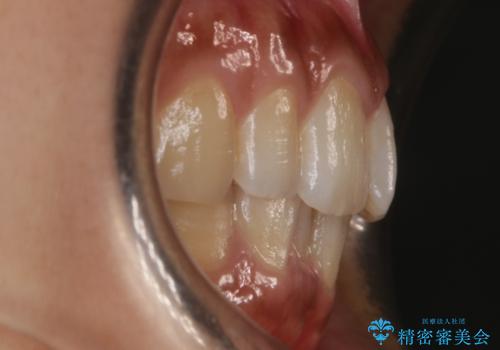 【非抜歯】ゴムかけで噛み合わせを改善!インビザライン治療の治療前