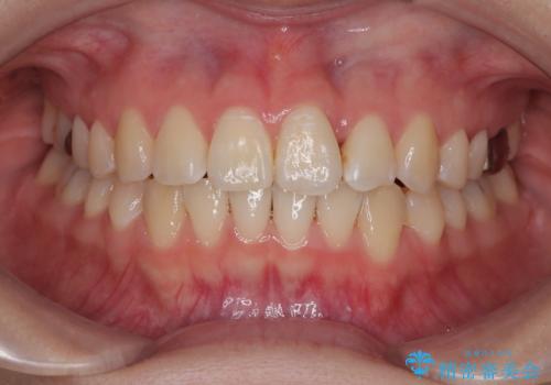 前歯のねじれ・ガタガタを10か月で改善!20代女性の矯正治療|クリアブラケットでむし歯になりにくい歯並びへ改善の治療後