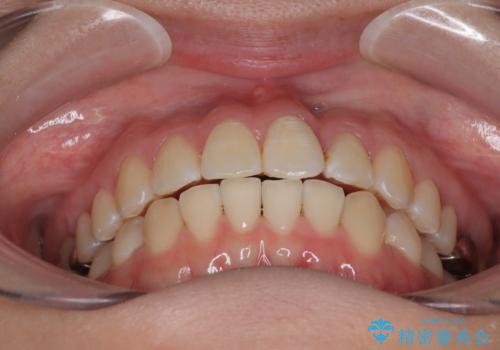 前歯のねじれ・ガタガタを10か月で改善!20代女性の矯正治療|クリアブラケットでむし歯になりにくい歯並びへ改善の治療後