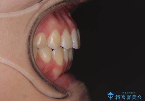 前歯のねじれ・ガタガタを10か月で改善!20代女性の矯正治療|クリアブラケットでむし歯になりにくい歯並びへ改善の治療後