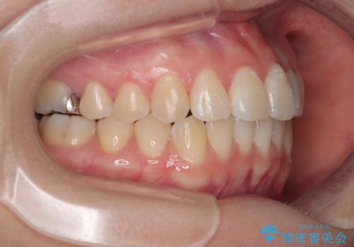 前歯のねじれ・ガタガタを10か月で改善!20代女性の矯正治療|クリアブラケットでむし歯になりにくい歯並びへ改善の治療後