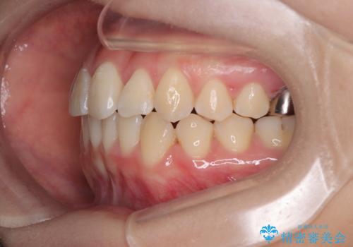 前歯のねじれ・ガタガタを10か月で改善!20代女性の矯正治療|クリアブラケットでむし歯になりにくい歯並びへ改善の治療後