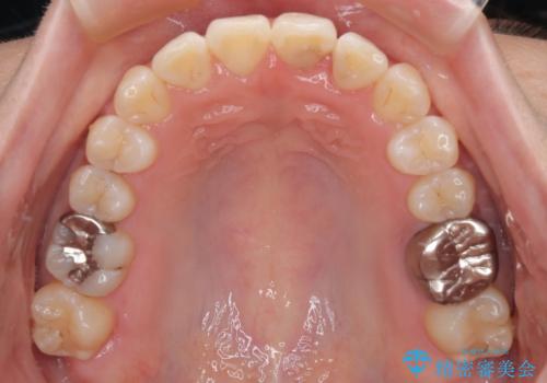 前歯のねじれ・ガタガタを10か月で改善!20代女性の矯正治療|クリアブラケットでむし歯になりにくい歯並びへ改善の治療後