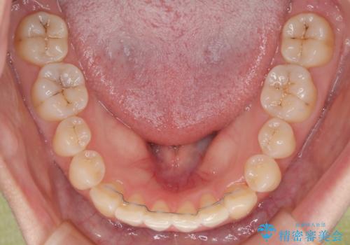 前歯のねじれ・ガタガタを10か月で改善!20代女性の矯正治療|クリアブラケットでむし歯になりにくい歯並びへ改善の治療後