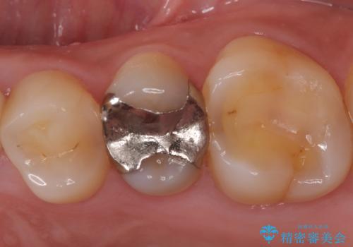 銀歯をやり替えたい 〈セラミッククラウン〉