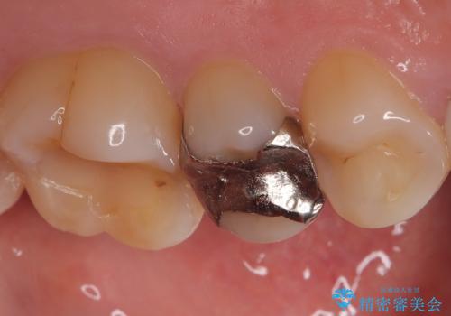 銀歯をやり替えたい 〈セラミッククラウン〉の治療前