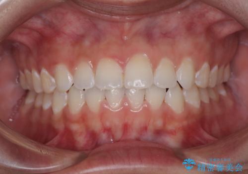 【モニター】マウスピース矯正が煩わしい ワイヤー装置での非抜歯矯正の症例 治療後