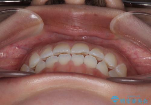 【モニター】マウスピース矯正が煩わしい ワイヤー装置での非抜歯矯正の治療後