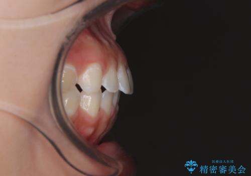 【モニター】マウスピース矯正が煩わしい ワイヤー装置での非抜歯矯正の治療後