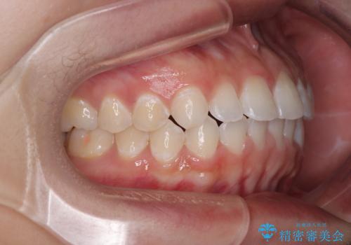 【モニター】マウスピース矯正が煩わしい ワイヤー装置での非抜歯矯正の治療後
