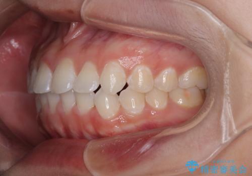 【モニター】マウスピース矯正が煩わしい ワイヤー装置での非抜歯矯正の治療後