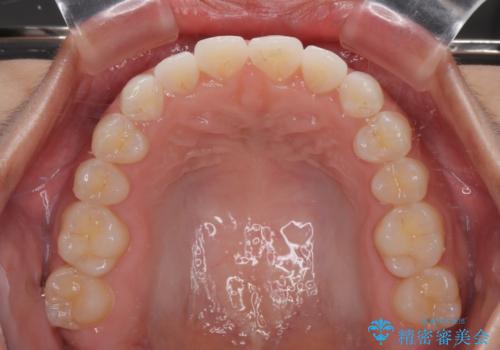 【モニター】マウスピース矯正が煩わしい ワイヤー装置での非抜歯矯正の治療後