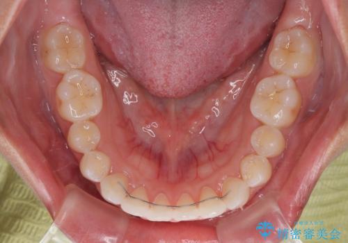 【モニター】マウスピース矯正が煩わしい ワイヤー装置での非抜歯矯正の治療後