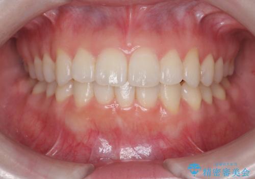 前歯のねじれをきれいに 部分ワイヤー+マウスピース矯正の症例 治療後