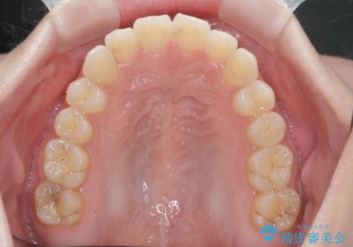 前歯のねじれをきれいに 部分ワイヤー+マウスピース矯正の治療後
