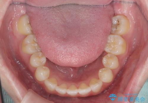 前歯のねじれをきれいに 部分ワイヤー+マウスピース矯正の治療後