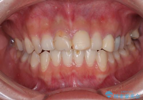 「抜歯してブリッジ」と言われた20代女性が選んだ治療とは?|たった4か月で自然な笑顔に|抜歯即時インプラント+審美補綴の症例の症例 治療前