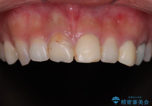 「抜歯してブリッジ」と言われた20代女性が選んだ治療とは?|たった4か月で自然な笑顔に|抜歯即時インプラント+審美補綴の症例の治療前
