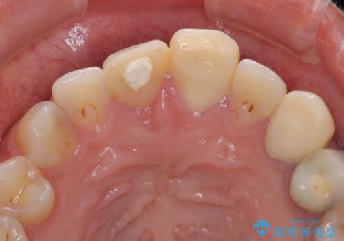 「抜歯してブリッジ」と言われた20代女性が選んだ治療とは?|たった4か月で自然な笑顔に|抜歯即時インプラント+審美補綴の症例の治療前