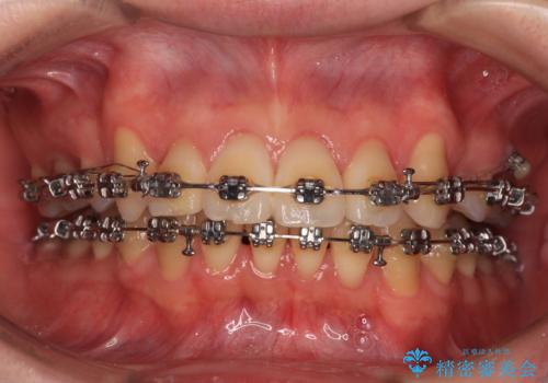 【モニター】八重歯とデコボコを治したい 補助装置を併用したワイヤー矯正の治療中