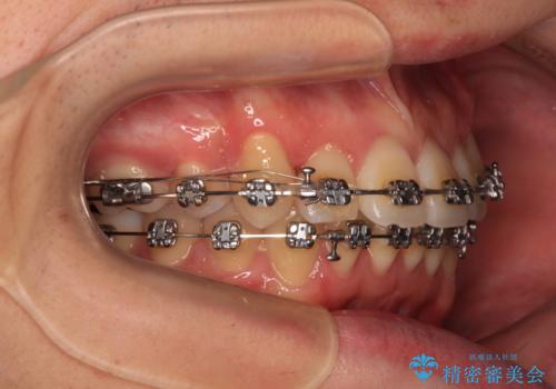 【モニター】八重歯とデコボコを治したい 補助装置を併用したワイヤー矯正の治療中