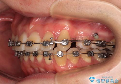 【モニター】八重歯とデコボコを治したい 補助装置を併用したワイヤー矯正の治療中
