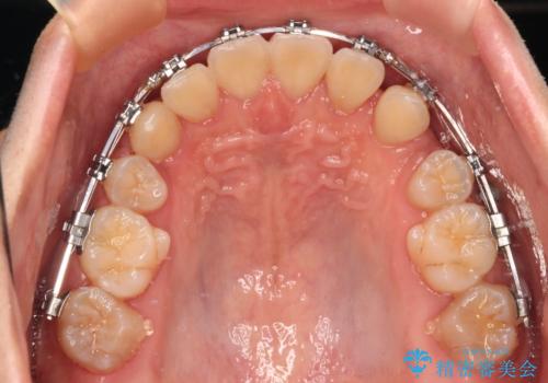 【モニター】八重歯とデコボコを治したい 補助装置を併用したワイヤー矯正の治療中