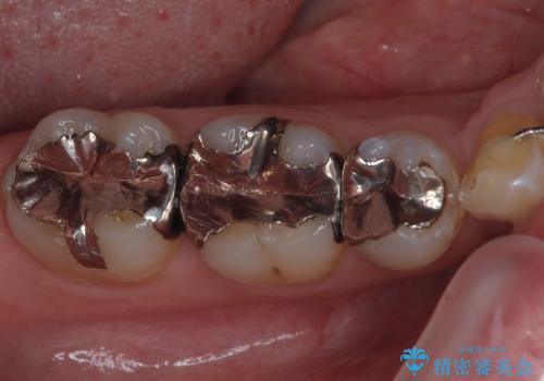 銀歯を白くしたい フルジルコニアクラウンの治療前