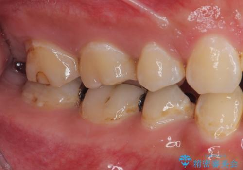銀歯を白くしたい フルジルコニアクラウンの治療前