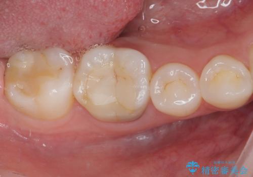 ラバーダム使用で再感染リスクを抑えた再根管治療+精密な補綴による長期安定を実現の症例 治療前