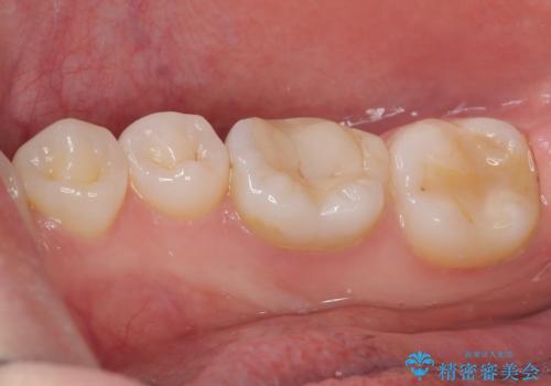 ラバーダム使用で再感染リスクを抑えた再根管治療+精密な補綴による長期安定を実現の治療前