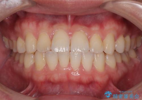 前歯のガタガタ・奥歯のかみ合わせ(シザーズバイト)を改善|1年半で完了したメタルブラケット矯正の治療後
