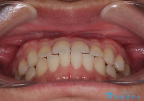 前歯のガタガタ・奥歯のかみ合わせ(シザーズバイト)を改善|1年半で完了したメタルブラケット矯正の治療後