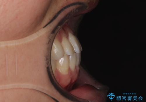 前歯のガタガタ・奥歯のかみ合わせ(シザーズバイト)を改善|1年半で完了したメタルブラケット矯正の治療後