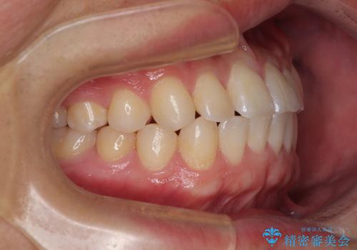 前歯のガタガタ・奥歯のかみ合わせ(シザーズバイト)を改善|1年半で完了したメタルブラケット矯正の治療後