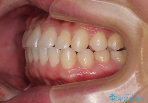 前歯のガタガタ・奥歯のかみ合わせ(シザーズバイト)を改善|1年半で完了したメタルブラケット矯正の治療後