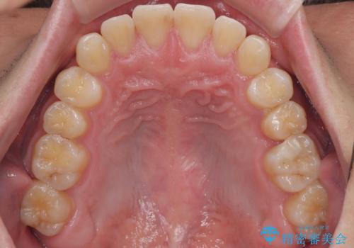 前歯のガタガタ・奥歯のかみ合わせ(シザーズバイト)を改善|1年半で完了したメタルブラケット矯正の治療後