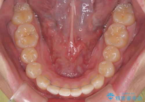 前歯のガタガタ・奥歯のかみ合わせ(シザーズバイト)を改善|1年半で完了したメタルブラケット矯正の治療後