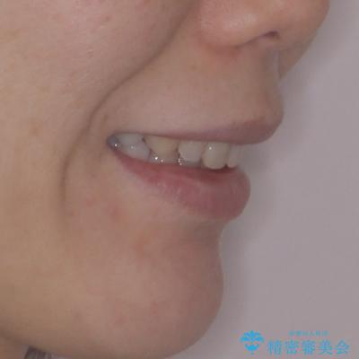 出っ歯を治したい ワイヤー装置での抜歯矯正の治療後(顔貌)