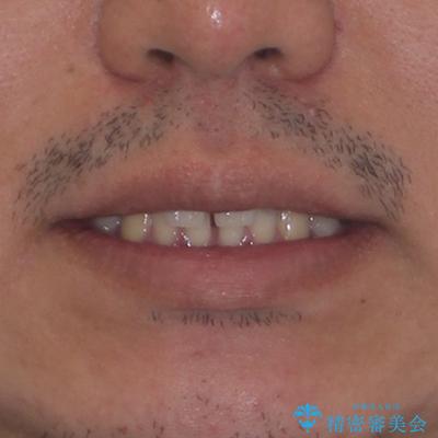 隙間だらけの歯列を治したい ワイヤー矯正での矯正治療の治療前(顔貌)