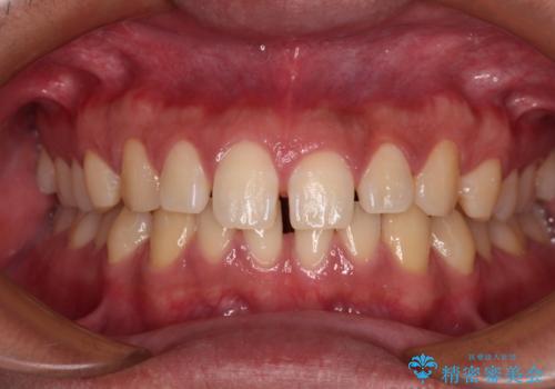 隙間だらけの歯列を治したい ワイヤー矯正での矯正治療の症例 治療前