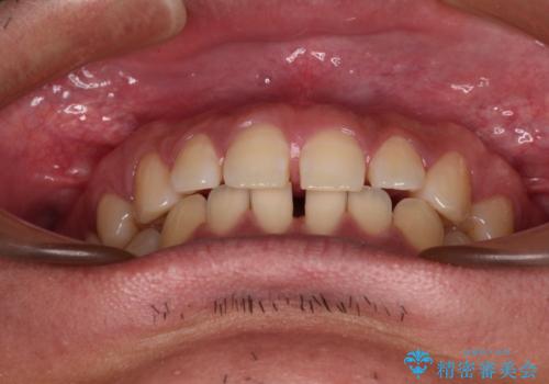 隙間だらけの歯列を治したい ワイヤー矯正での矯正治療の治療前