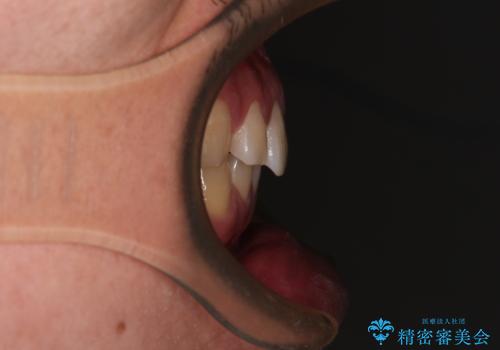 隙間だらけの歯列を治したい ワイヤー矯正での矯正治療の治療前