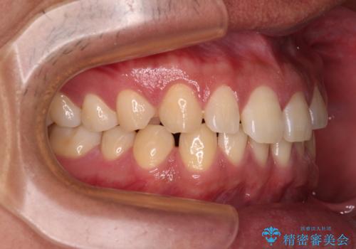 隙間だらけの歯列を治したい ワイヤー矯正での矯正治療の治療前