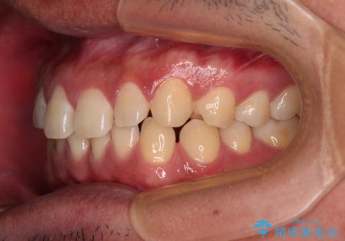 隙間だらけの歯列を治したい ワイヤー矯正での矯正治療の治療前