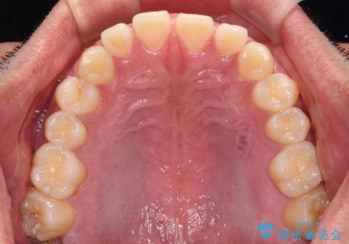 隙間だらけの歯列を治したい ワイヤー矯正での矯正治療の治療前